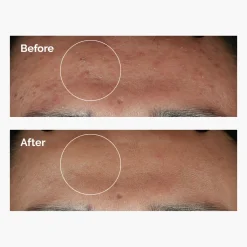 The Ordinary Niacinamide 10% + Zinc 1%
